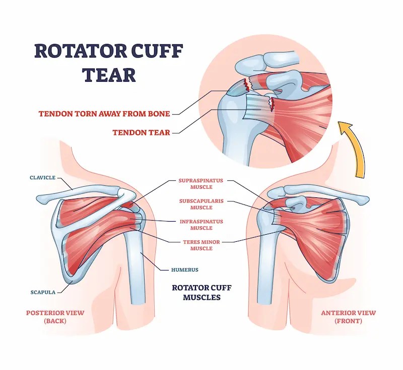 Milsons Point Health Rotator Cuff Tears